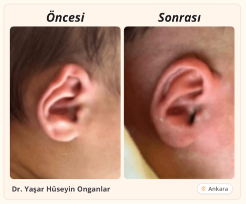Bebeklerde kulak şekillendirme öncesi sonrası — Uzm. Dr. Yaşar Hüseyin Onganlar