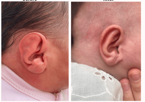 Bebeklerde yelken kulak düzeltme öncesi sonrası — CranioWell