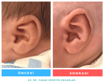 Bebeklerde kulak şekillendirme öncesi sonrası — Uzm. Dr. Yaşar Hüseyin Onganlar