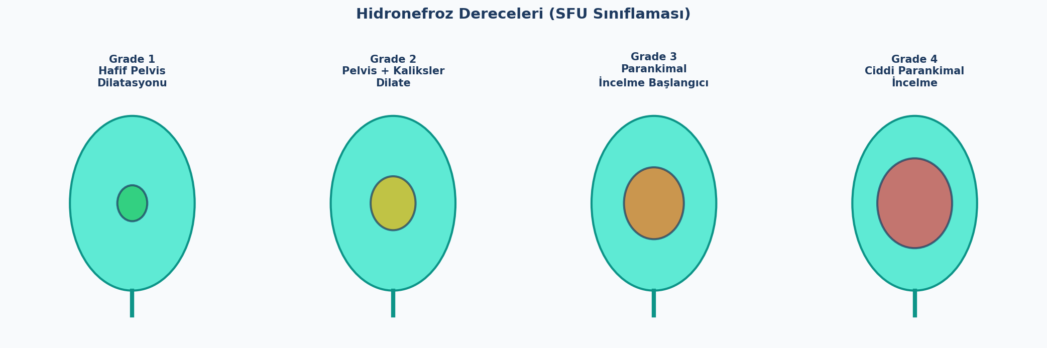 Hidronefroz Dereceleri