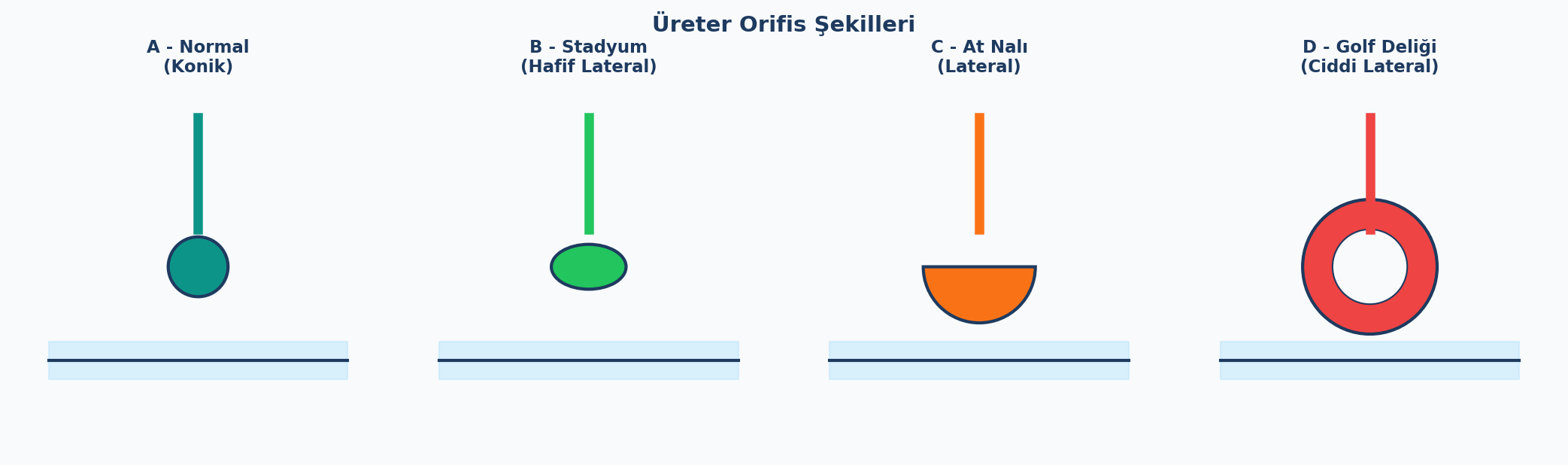 Üreter Orifis Şekilleri