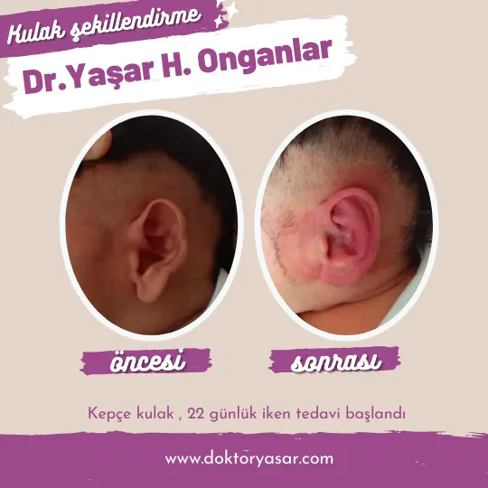 bebeğin kulak memesi kalkık