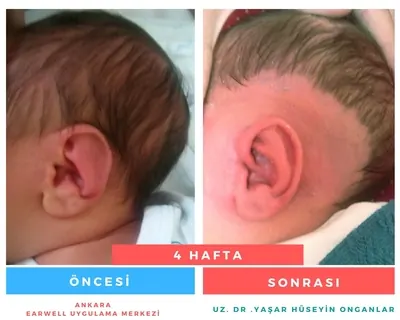 kulak şekil bozukluğu var