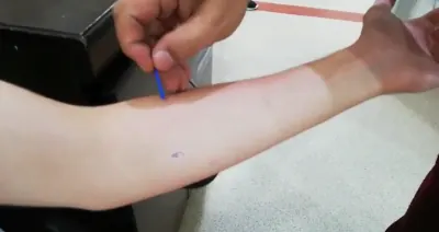 alerji testi nasıl yapılır