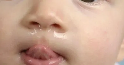 çocuklarda alerjik viral burun akıntısı
