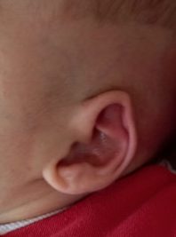 bebeklerde kulak kıvrılması