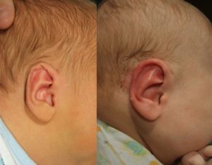 Bebek Kulak Kıvrılması