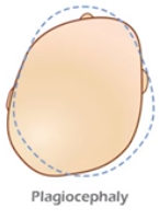 deformasyonel plagiosefali